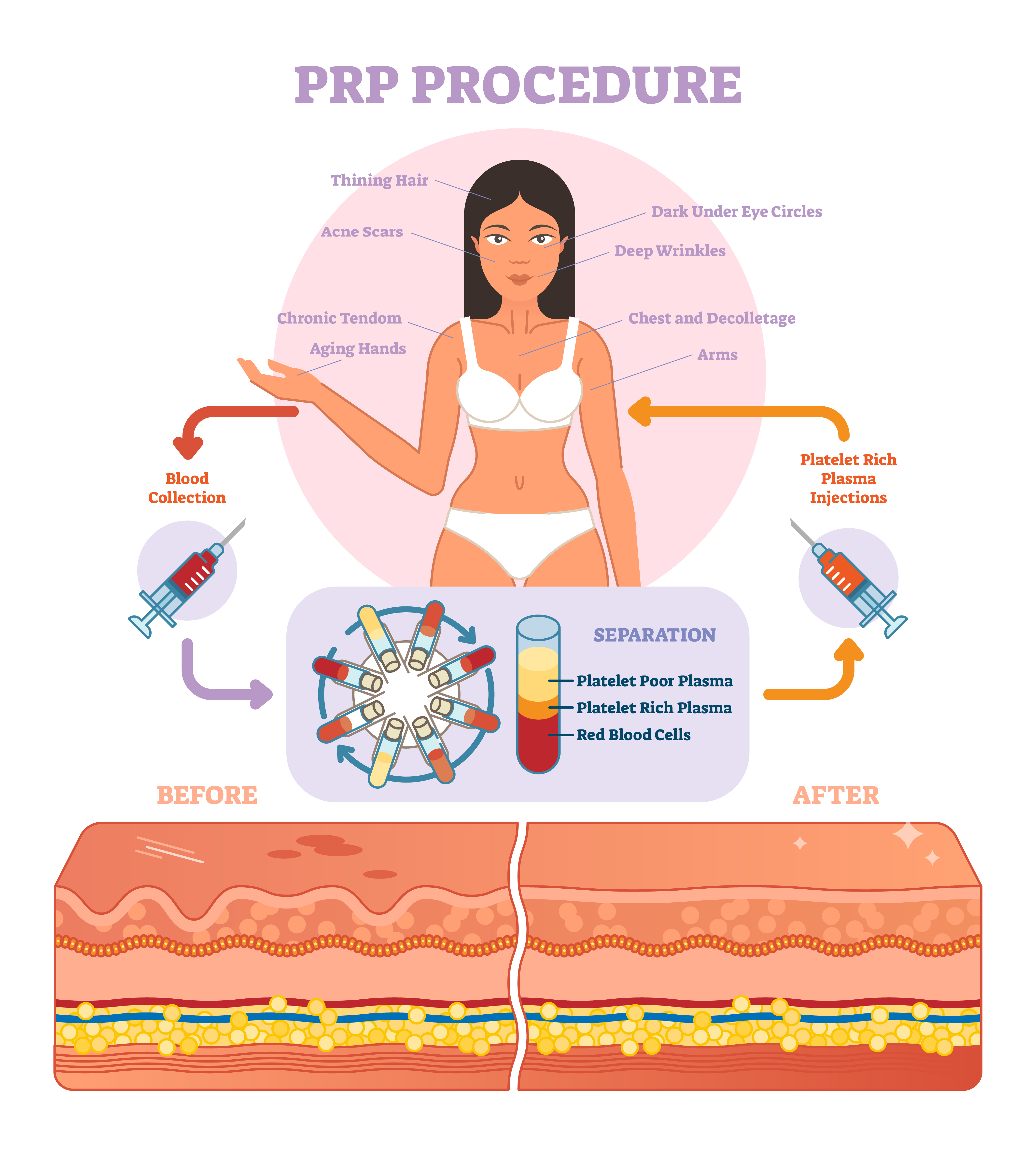 platelet rich plasma therapy